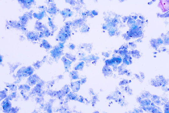 View in microscopic of human skin cells.Squamous epithelium cells.Bacterial vaginosis in pap smear.Cytology and pathology laboratory department.Magnification 400 X