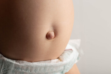 Umbilical hernia in newborns on the stomach, close-up. Treatment of hernias in children without...