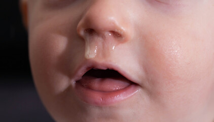Yellow snot from a child s nose, close-up. Sinus infections, colds and virus. Chronic runny nose, adenoviruses - 787161407