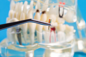 A dental metal pin in tweezers against the background of a medical model of a dental jaw. The concept of installing a dental crown on a post in orthodontics, macro. - 787161470