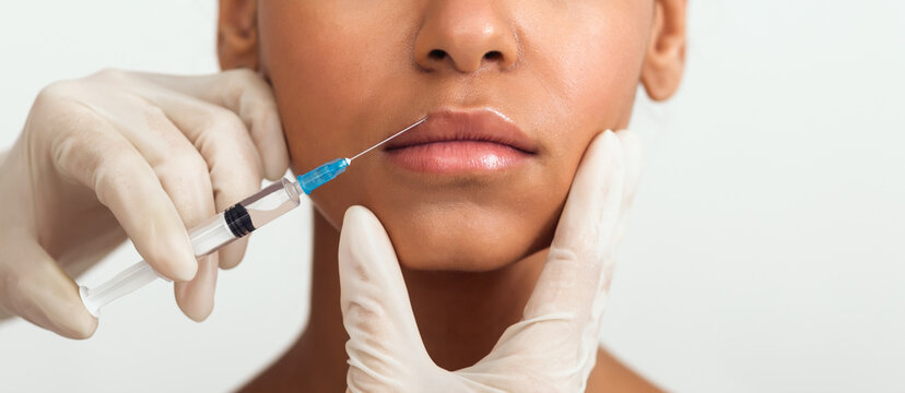 Close-up view of filler injection in lips