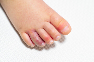 しもやけになった幼児の足の写真。