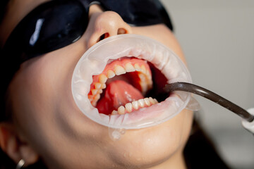 close-up in the dental office of young beautiful girl with a speculum in her mouth and black glasses