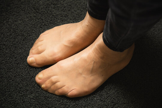Flat feet and foot toe problems, What Problems Can Flat Feet Cause. High quality photo. 