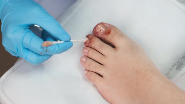 Close up podologist treats the nail with an antifungal agent. 