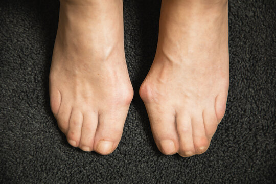 Flat feet and foot toe problems, What Problems Can Flat Feet Cause. High quality photo. 