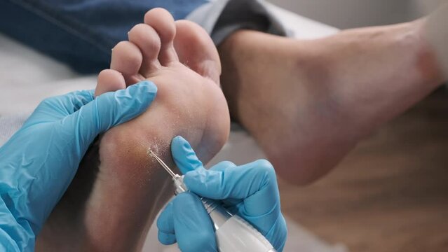 Podologist removes a callus on a patients toe. 