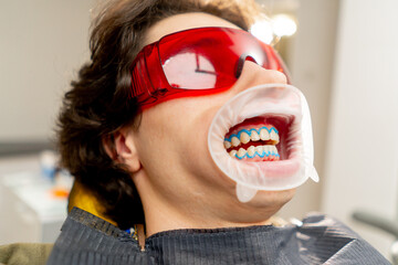 close up in the dental office guy sits during a whitening procedure with protective gel applied to his teeth