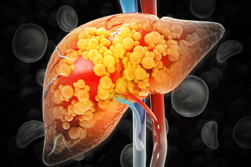 Liver damage such as Fatty liver, Fibrosis, Cirrhosis, and Liver cancer. 3d illustration