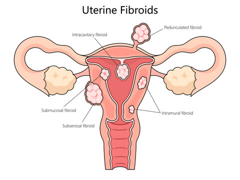 Human various types of uterine fibroids, including submucosal, subserosal, and intramural fibroids structure diagram hand drawn schematic vector illustration. Medical science educational illustration