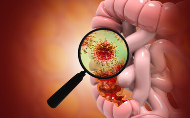 Colon cancer, Viral infection, Colon disease concept.  3d illustration