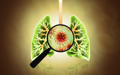 Virus and bacteria infected the Human lungs.lung disease.3d illustration