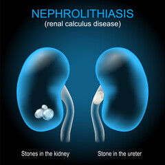 Kidney stone disease. Renal calculus. Nephrolithiasis or urolithiasis