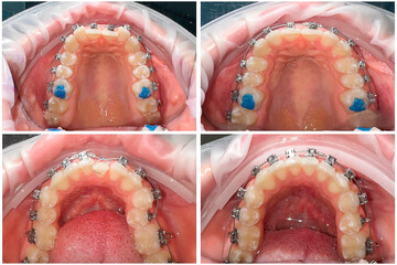 before and after braces are installed. Upper and lower jaw. Correction of teeth using braces.