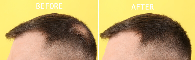 Young man before and after hair loss treatment on yellow background, closeup