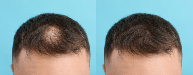 Young man before and after hair loss treatment on light blue background, closeup