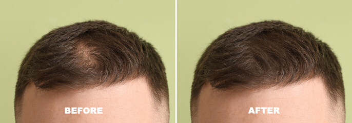 Young man before and after hair loss treatment on color background, closeup