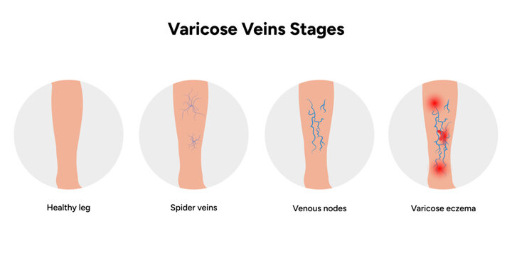 Varicose vein. Healthy leg and spider veins, venous nodes, varicose eczema. Varicose veins stages