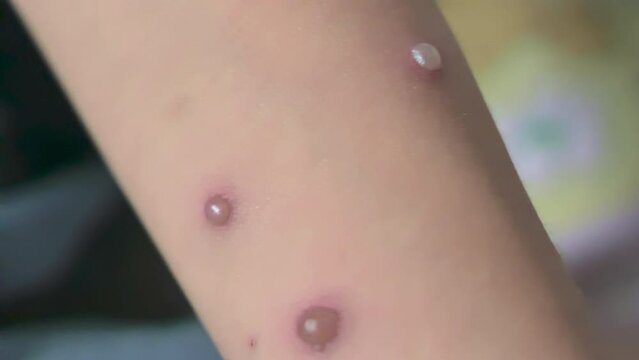Understanding Monkeypox-Like Blisters on Children's Skin: Close-Up Footage 4K. Monkey pox like bubbles on the hand of a young southeast Asian child.