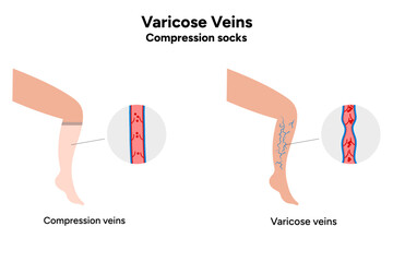 Compression socks and Varicose veins