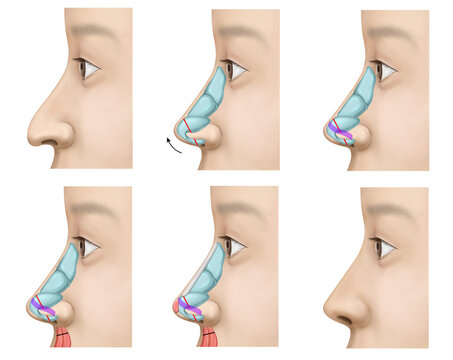rhinoplasty