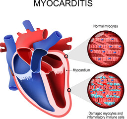 Myocarditis. inflammatory cardiomyopathy. Cross section of a human heart and Myocardium.