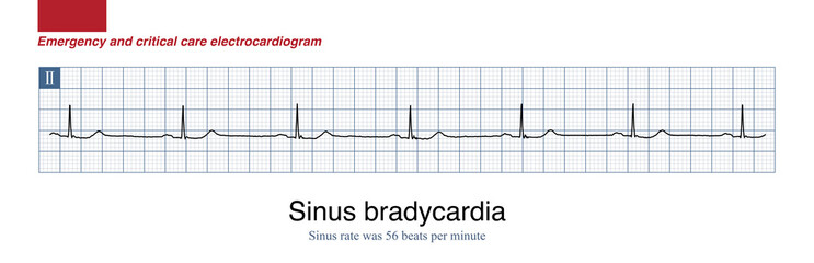 Male, 71 years old, was clinically diagnosed with upper gastrointestinal bleeding. During sleep at night, ECG monitoring showed sinus bradycardia, blood pressure 115 and 70mmHg.