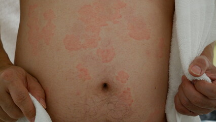 Close up image of skin texture suffering severe urticaria or hives or kaligata on a man body....