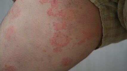 Close up image of skin texture suffering severe urticaria or hives or kaligata on a man's thighs....