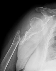 Film x ray or radiograph of an adult shaft of the humerus neck upper arm bone with a complete break or fracture.  Broken arm bone