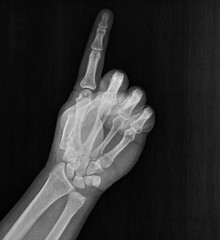 Film xray x-ray or radiograph of a hand and fingers showing the number one 1 in gestural language, manual communication, or signing aka sign language, we are number # 1 or first place - obrazy, fototapety, plakaty