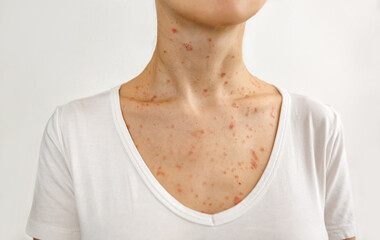 A skin diseases that worsen the quality of human life. Dermatitis, allergy, eczema, psoriasis...