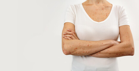 Areas of the body affected by skin diseases. Dermatitis, allergy, eczema, psoriasis concept. - obrazy, fototapety, plakaty