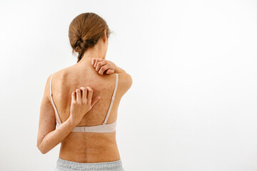 Itching and burning of painful areas of the skin in which the girl scratches her back.