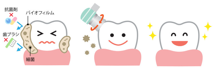 歯のバイオフィルム除去