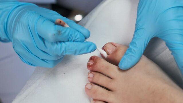 Close up podologist treats the nail with an antifungal agent. 