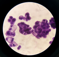 Malignant fluid cytology; Cells of adenocarcinoma may spread to fluid of pleural or peritoneal...