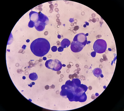 Malignant fluid cytology; Cells of adenocarcinoma may spread to fluid of pleural or peritoneal cavity in cancer from the breast, lung, colon, pancreas, ovary, endometrium or other sites.