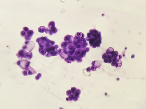 Malignant fluid cytology; Cells of adenocarcinoma may spread to fluid of pleural or peritoneal cavity in cancer from the breast, lung, colon, pancreas, ovary, endometrium or other sites.