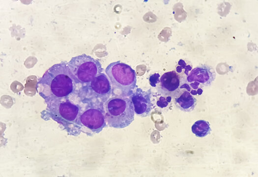 Malignant fluid cytology; Cells of adenocarcinoma may spread to fluid of pleural or peritoneal cavity in cancer from the breast, lung, colon, pancreas, ovary, endometrium or other sites.