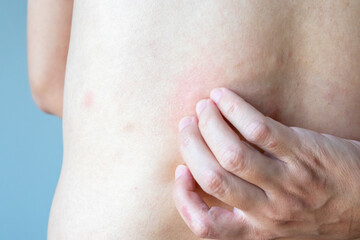 Young asian man itching and scratching on his back from allergic itchy dry skin eczema dermatitis insect bites - 789473063
