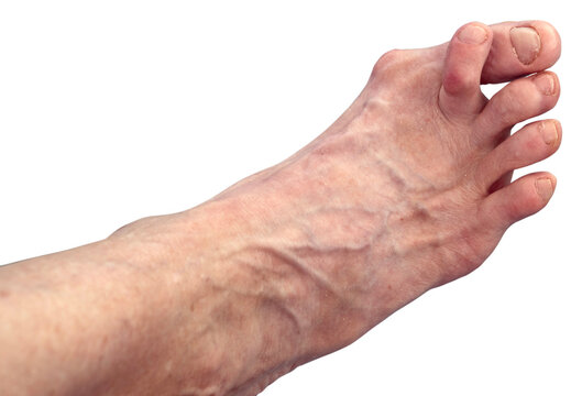 Isolated woman's hammer toe and bunion.
