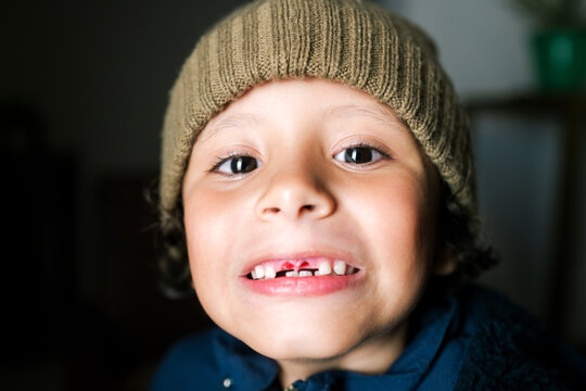 Child showing missing teeth.