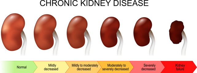 Chronic kidney disease. Stage of disorder - obrazy, fototapety, plakaty