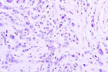 Backgrounds of human cells tissue of lung human under the microscope in pathology lab.View in...
