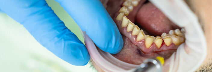 The dentist treats the patient's teeth, photo of the open mouth of the patient who came to the...