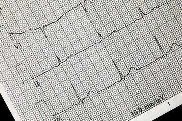 Electrocardiography (ECG or EKG) graph showing heart activity