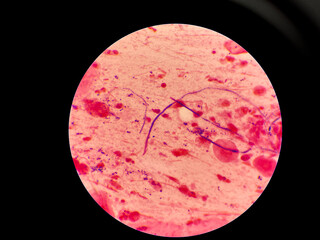 Mold yeast cell in sputum gram stain.