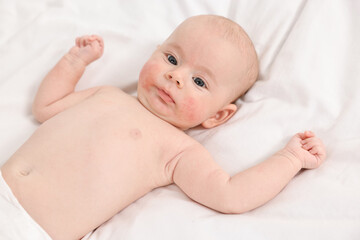Cute little baby with allergic redness on cheeks lying on white blanket
