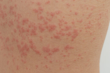 Fototapeta premium acute Urticaria allergy on woman's back